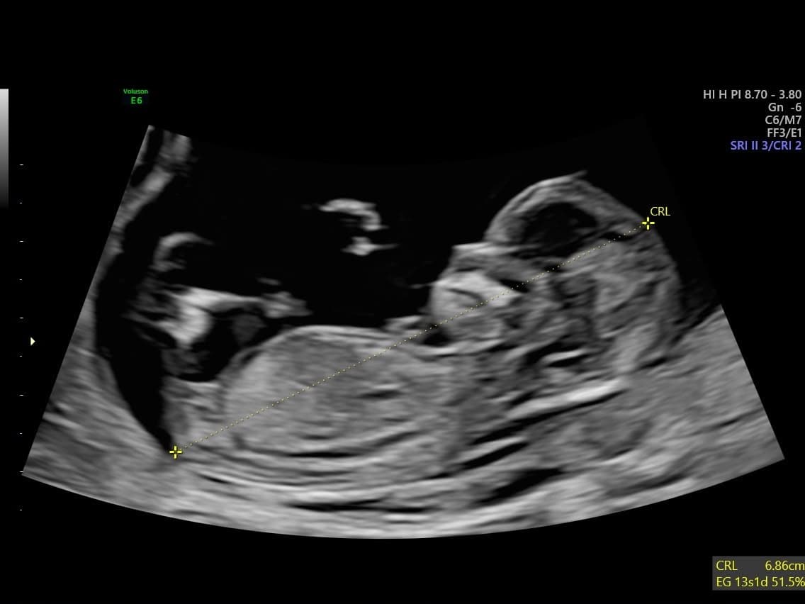 Ecografía del primer bebé de Sergio y Alexia, la integrante más pequeña del equipo.